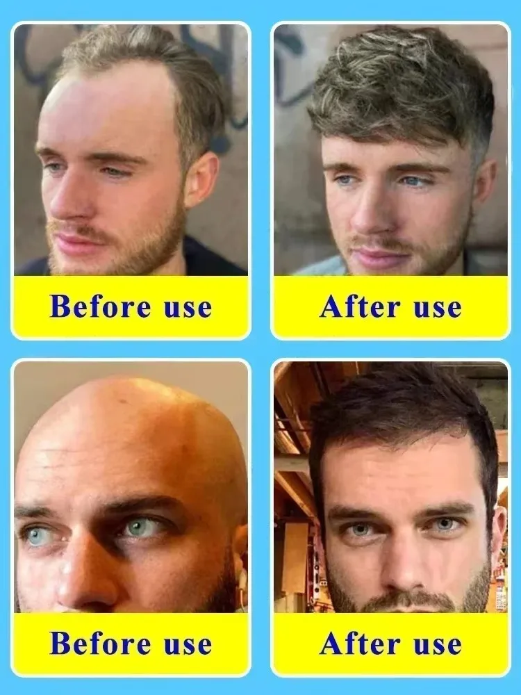 Hair Growth Oil Have More And More Hair Say Goodbye To Baldness Thick Hair