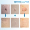 2 IN 1 Auto Skin Tag Remover Kit Micro Skin Tag Removal Device Adult Mole Stain Wart Remover Face Care Beauty Tools Dropshipping 4