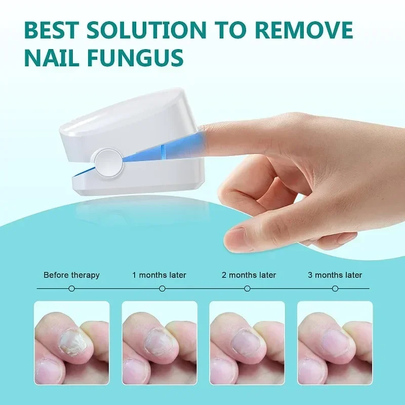 Effective Remover Fungus Machine Repair Nail Laser Fungus Device Damage Rechargeable Cleaning Nail Phototherapy Auxiliary Tools