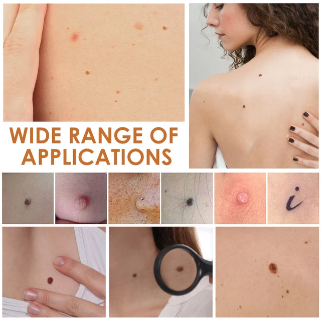 Laser Plasma Pen for Skin Tag Remover Freckle Black Dot Papilloma Warts Mole Pimples 4