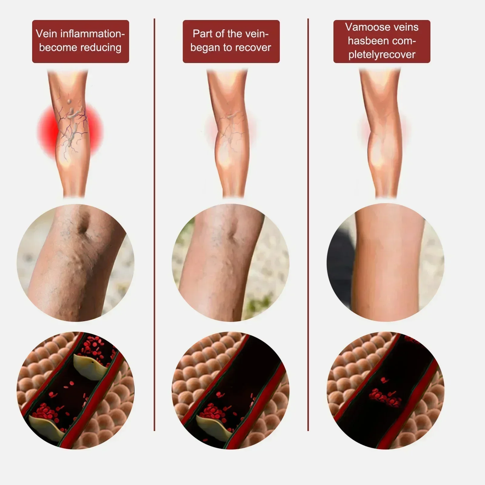 Safe and effective varicose vein removal Effective treatment of vasculitis Fast treatment of leg varicose vein removal Fast