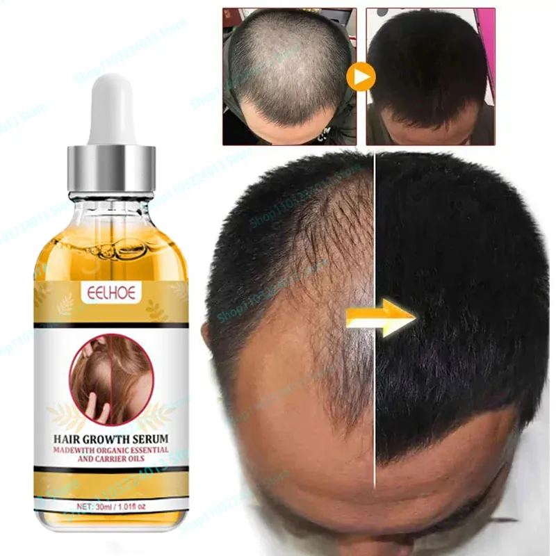 

Strong Effect Hair Growth Products Ginger Essential Oil 2 Week Treat Hair Loss Scalp Repair Nourish Hair Roots Regrowth