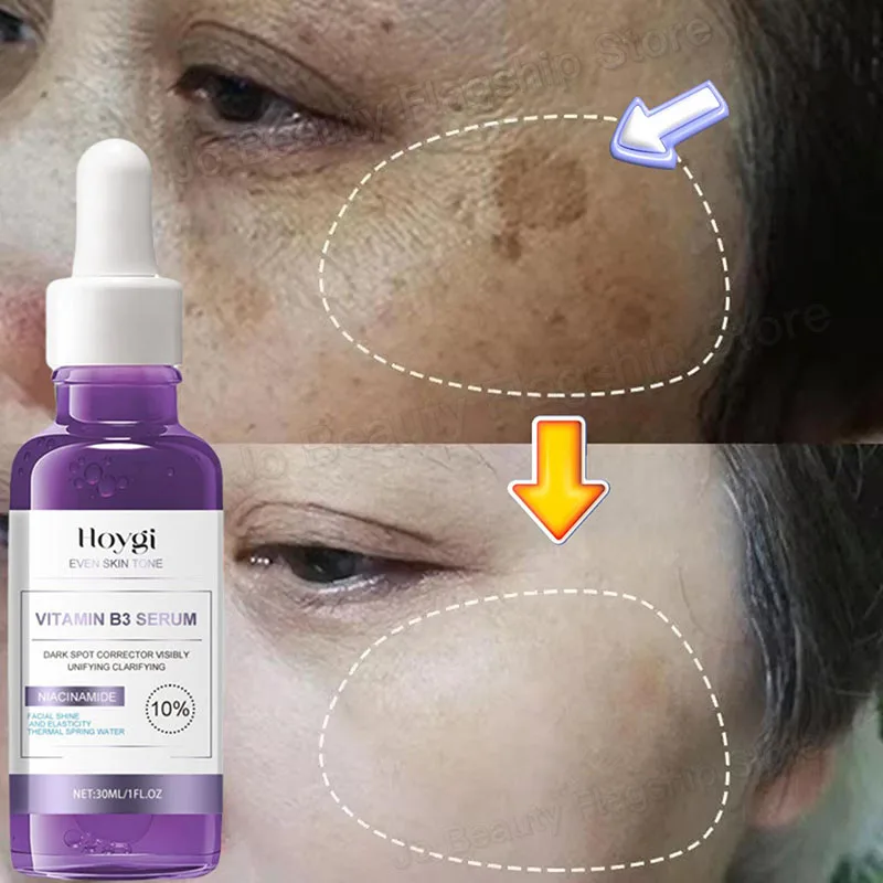 Dark Spots Remover Whitening Facial Serum Face Freckle Melanin Correcting Anti Pigmentation Brighten Skin Care