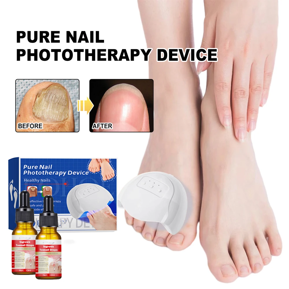 Fungal Nail Laser Treatment Device for Toenail