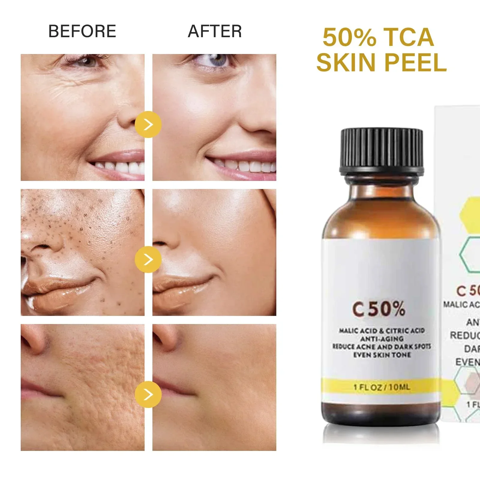 Acid Peeling Serum Chemical Exfoliant Peel for remove Face Dark Skin Spots Whiten Lighten Melanin Peeling Solution Skin P bleaching skin care set
