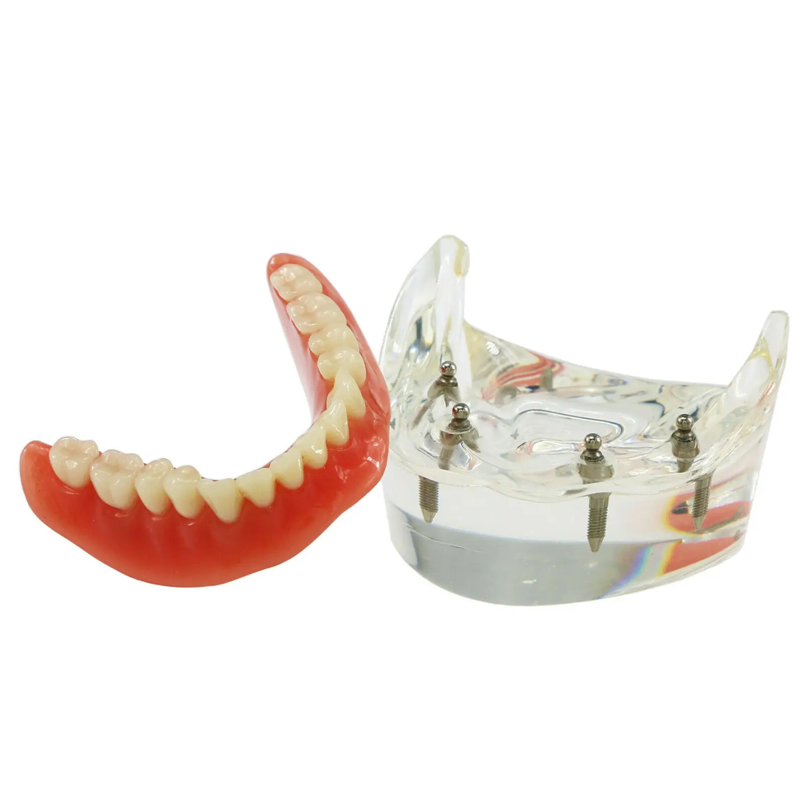 NEW Dental Implant Tooths Model Overdenture Inferior with 4 Implants Demo #6003