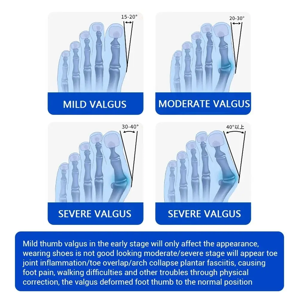 Adjustable Bunion Corrector with Anti-slip Heel Strap Breathable Rotatable Toe Braces Comfortable Easy To Wear