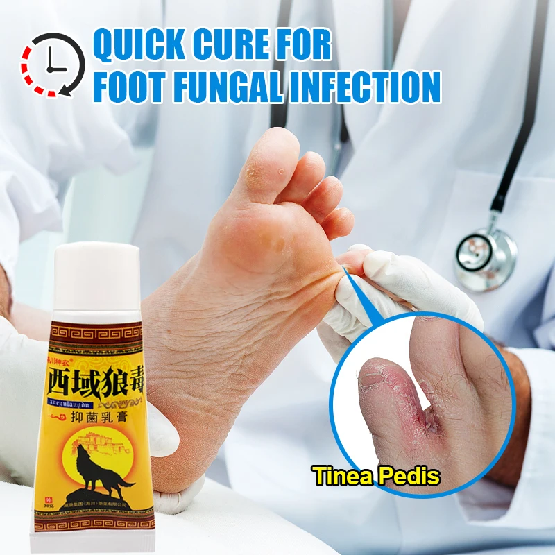 

30g Natural Foot Odor Remove Ointment Inhibits Fungus Lnfections Peeling Antipruritic Dressing Tinea Pedis Foot Beriberi Cream