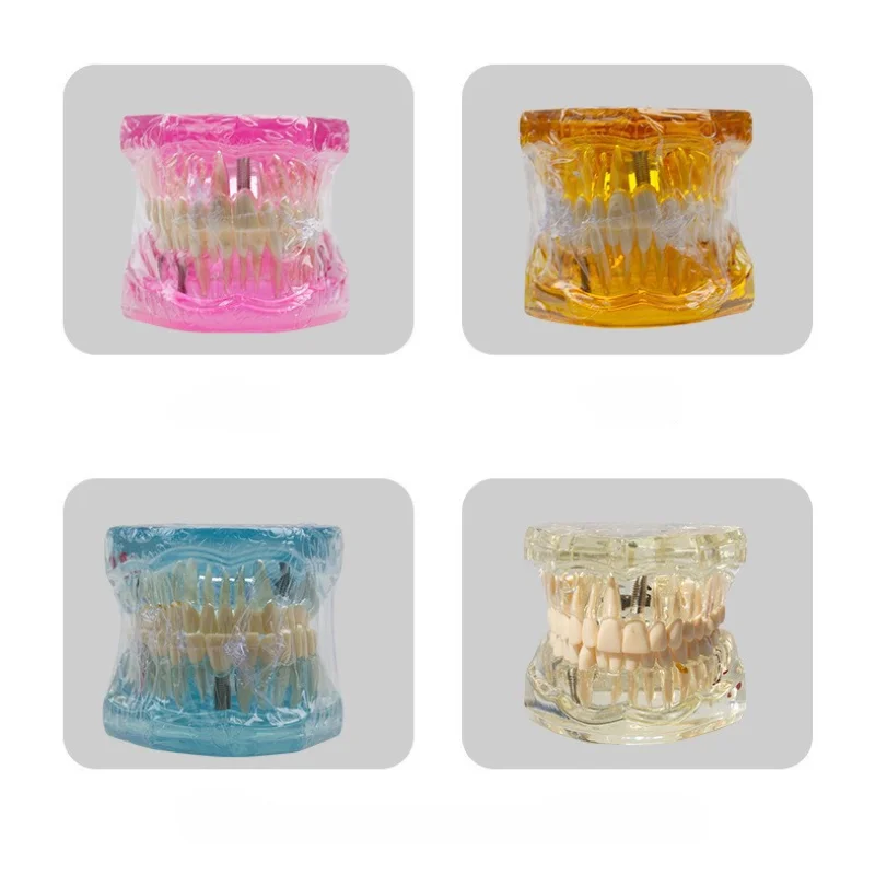 탈착식 치과 임플란트 복원 교육 모델, 의사-환자 의사소통 시뮬레이션 의료 교육 도구