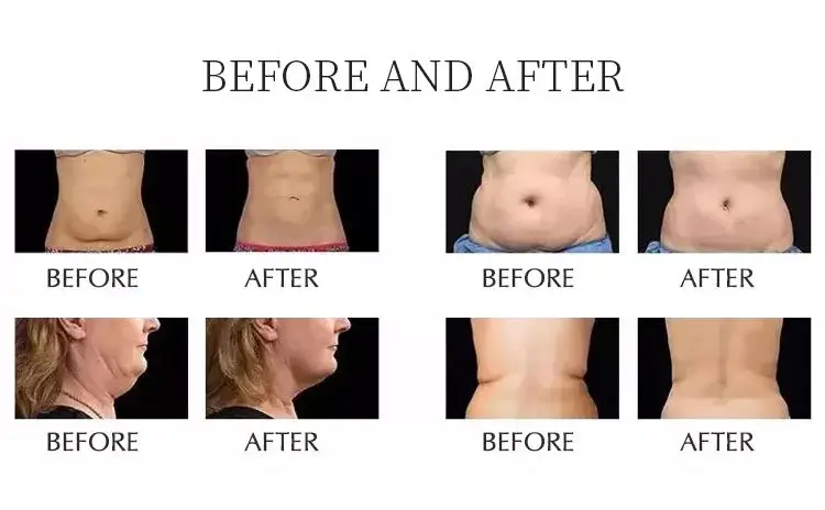 80k professional 6-1 Fast slim 80K cavitation Lipo rf ultrasonic cavitation slimming machine