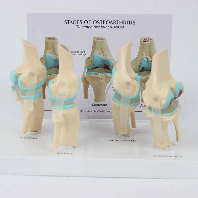 Medical Science Teaching Aids Stage 4 Knee Joint Model with Back Card Orthopedic Teaching Display Aids
