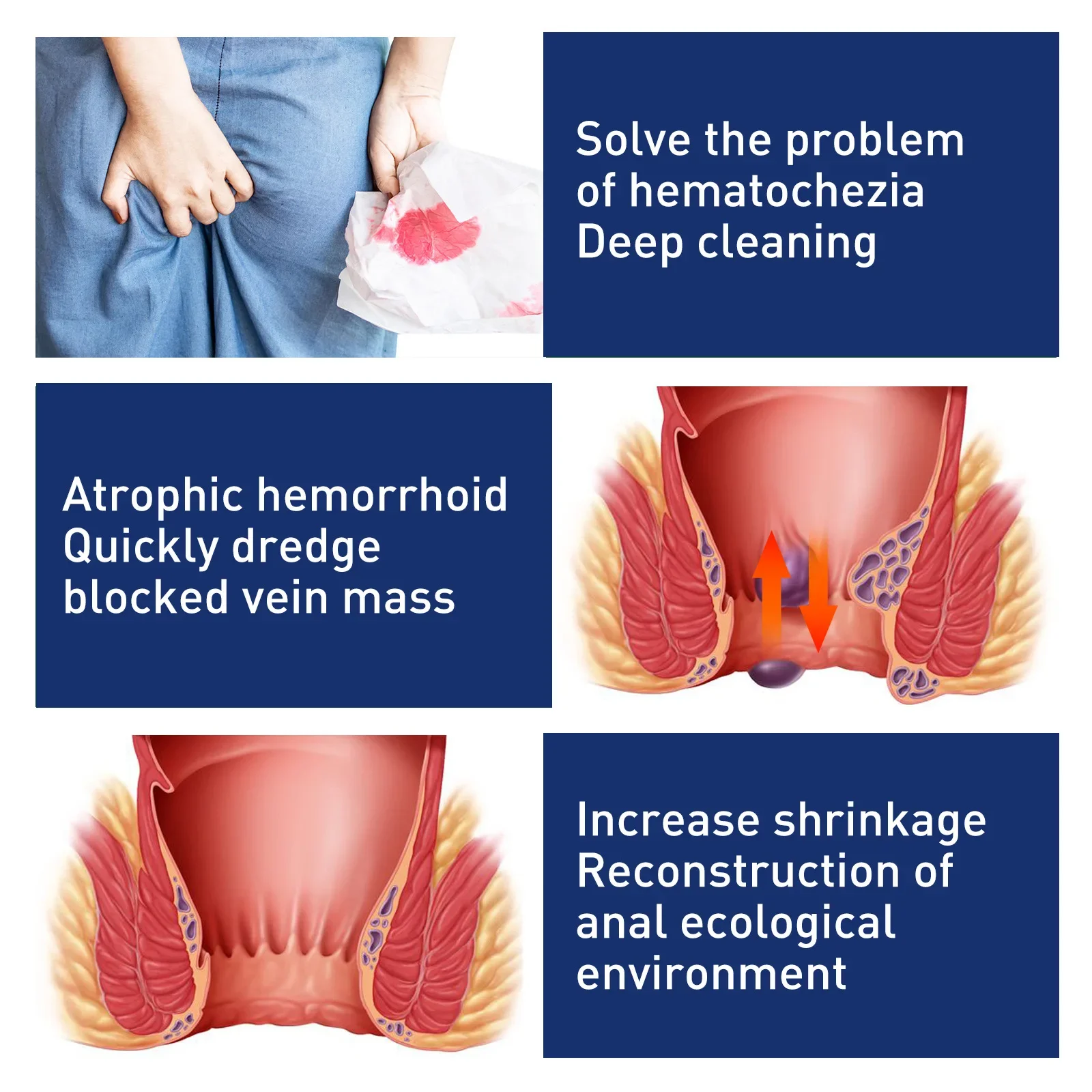Hemorrhoid Remover Cream Treatment Mixed Hemorrhoids Anal Pain Relief Eliminate Meat Ball Antibacterial Hemorrhoids Ointment 20g