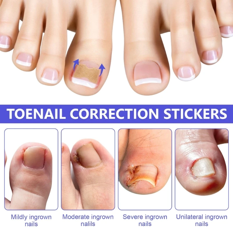 Toenail corrector patch 100pcs paronychia correction ingrown tools pedicure removal stickers