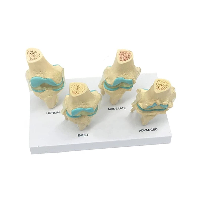 Four-stage Human Pathological Knee Joint Anatomy Model Medical Science Teaching Resources