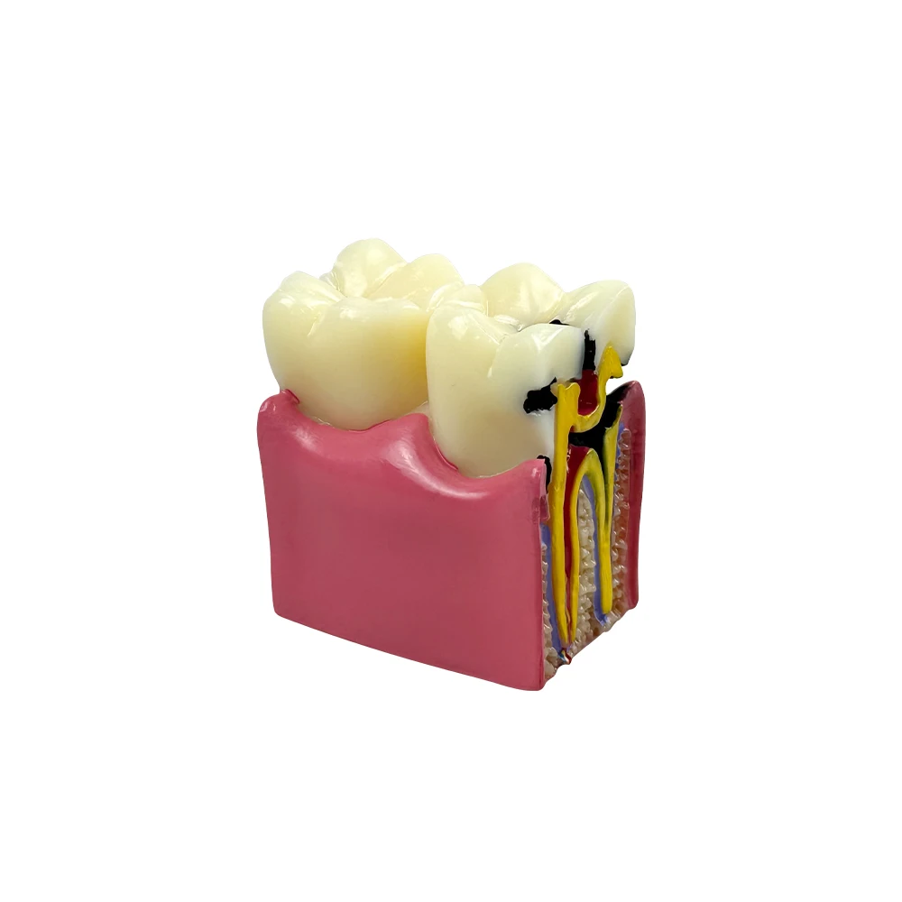 Dente Dentale Odontoiatria Apprendimento Dello Studente Modello Didattico Che Mostra Denti Radici Gomme Malattie Gengivali Carie E Placca 133005054