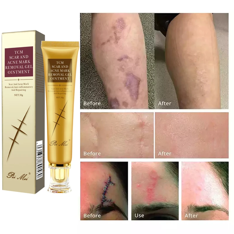 Herbal Scar Removal Cream Repair Stretch Marks Gel Remove Burn Scars