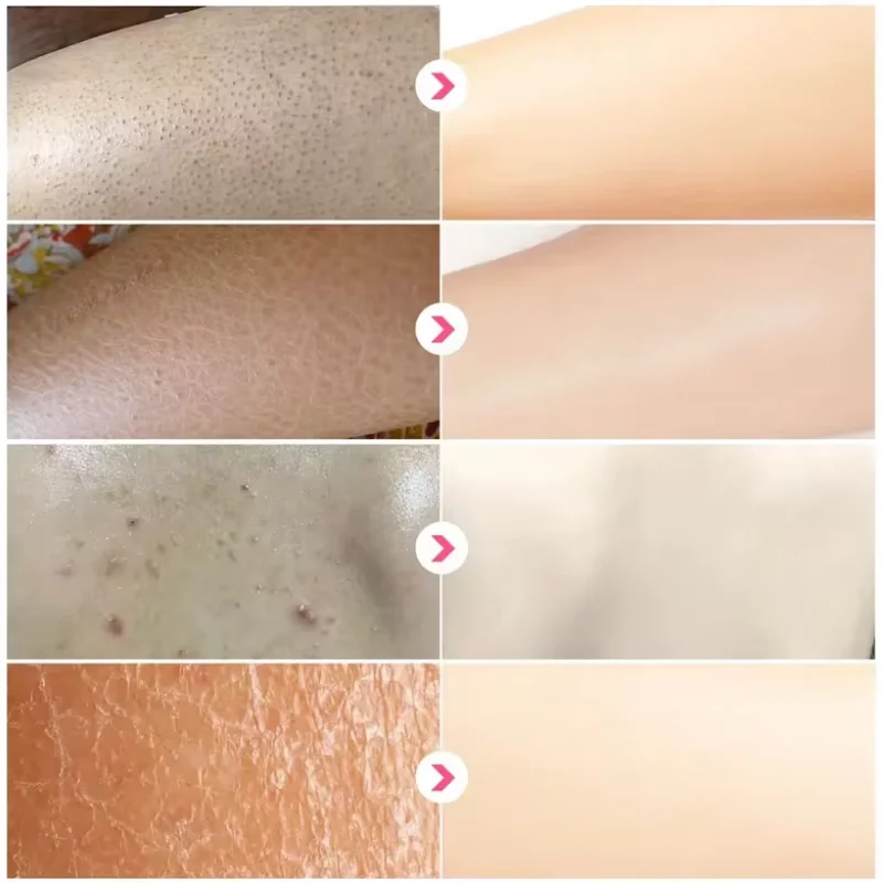 Curing Keratosis Pilaris Chicken Follicle Skin Repair Cream Body Dark Spot Remove Whiten Smooth Moisturize Skincare Body Lotion whitening body cream whitening cream body lotion brightening cream body care brightening body cream body skin care cream