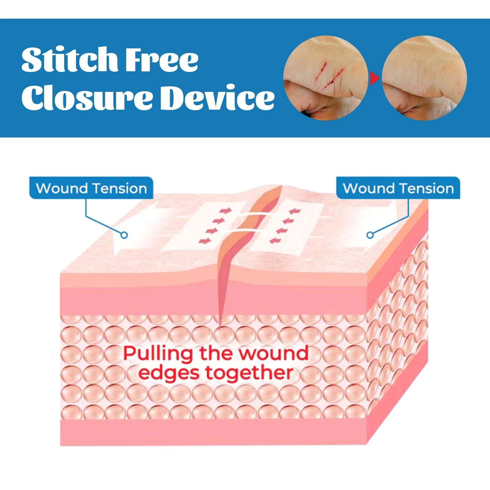 South Moon Portable Wound Closure Patch Painless Suture Zipper Band-Aid Repair Wounds Waterproof Stitch Free Hemostatic Sticker