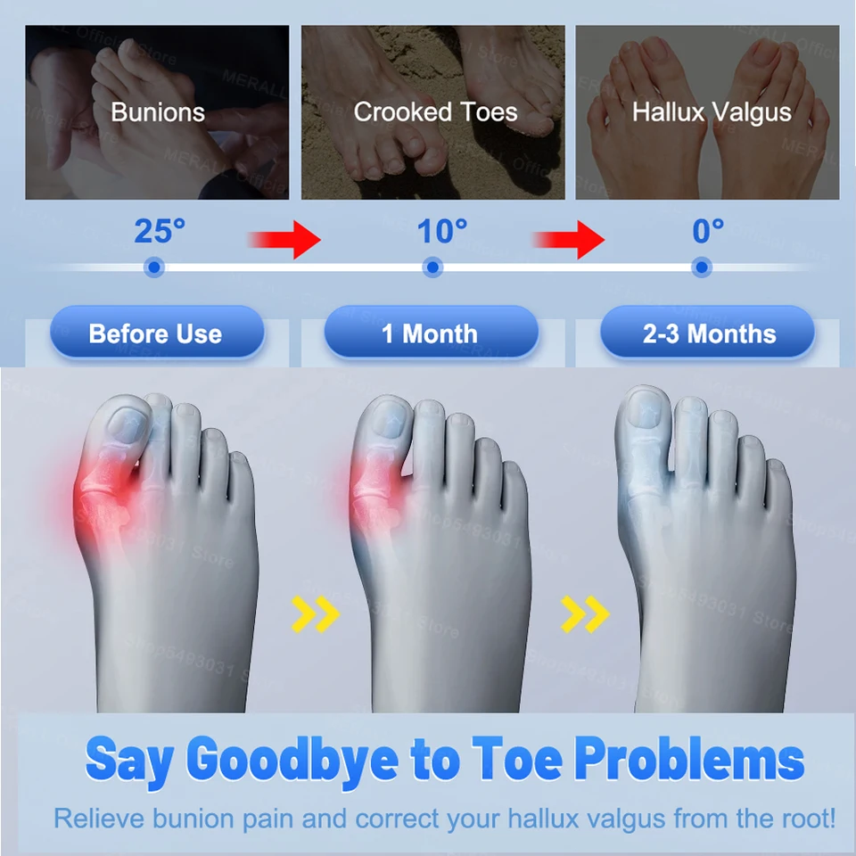 Separatore regolabile per alluce valgo, correttore per dita dei piedi, raddrizzatore per dita dei piedi, pedicure ortopedica_voghion.com