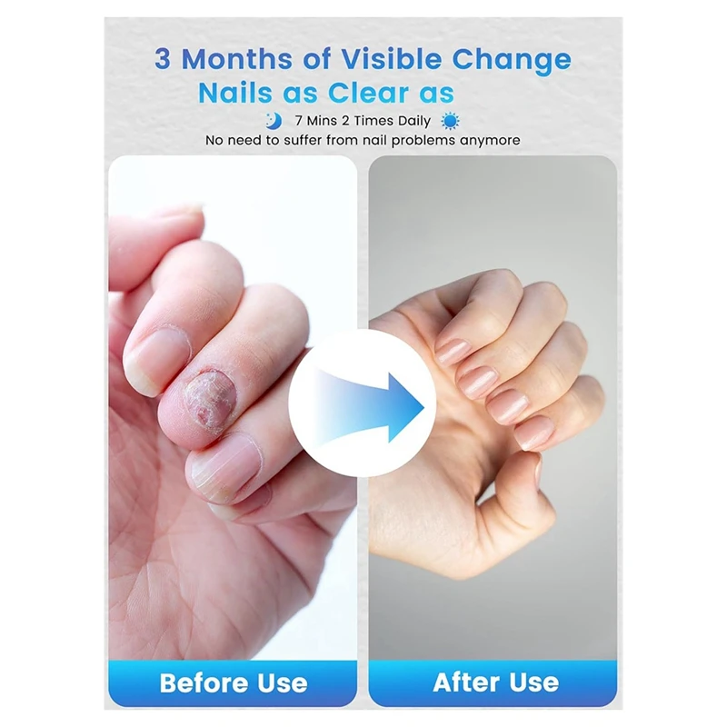 Nail Fungu Cleaning Device Home Use Nail Fungu Hand Andtoenail Repair Fordiscolored Andthickened Toenail nail fungus cleaner