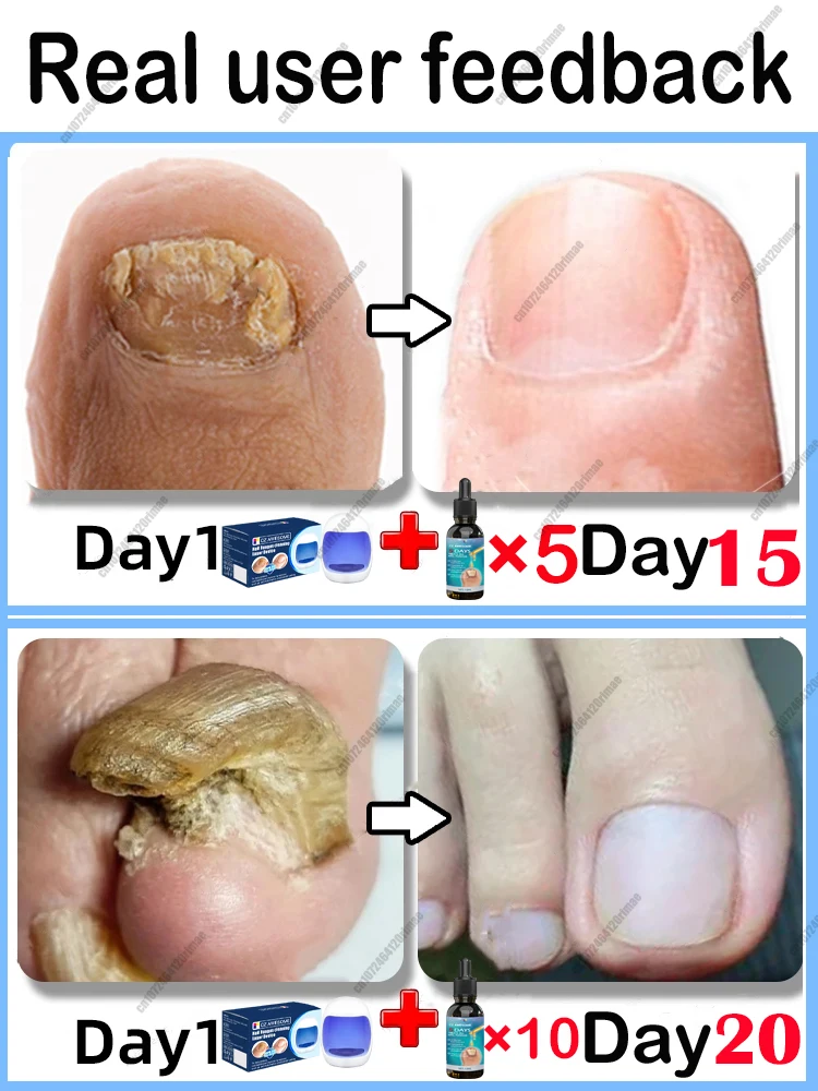 Réparation rapide de l\'appareil laser à ongles fongique N64.Fungus Onychomycosis