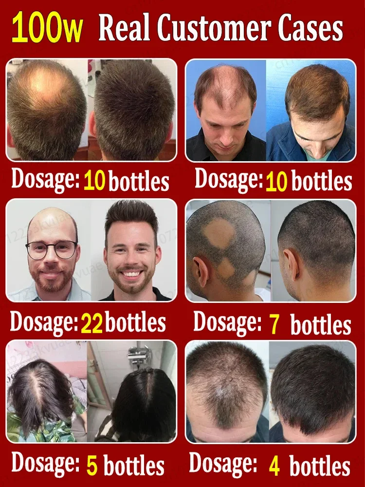 Rapid hair growth essential oil, repair baldness