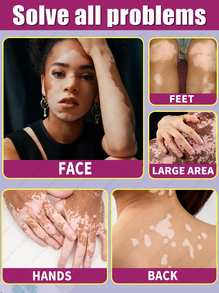 Improve vitiligo laser laser treatment