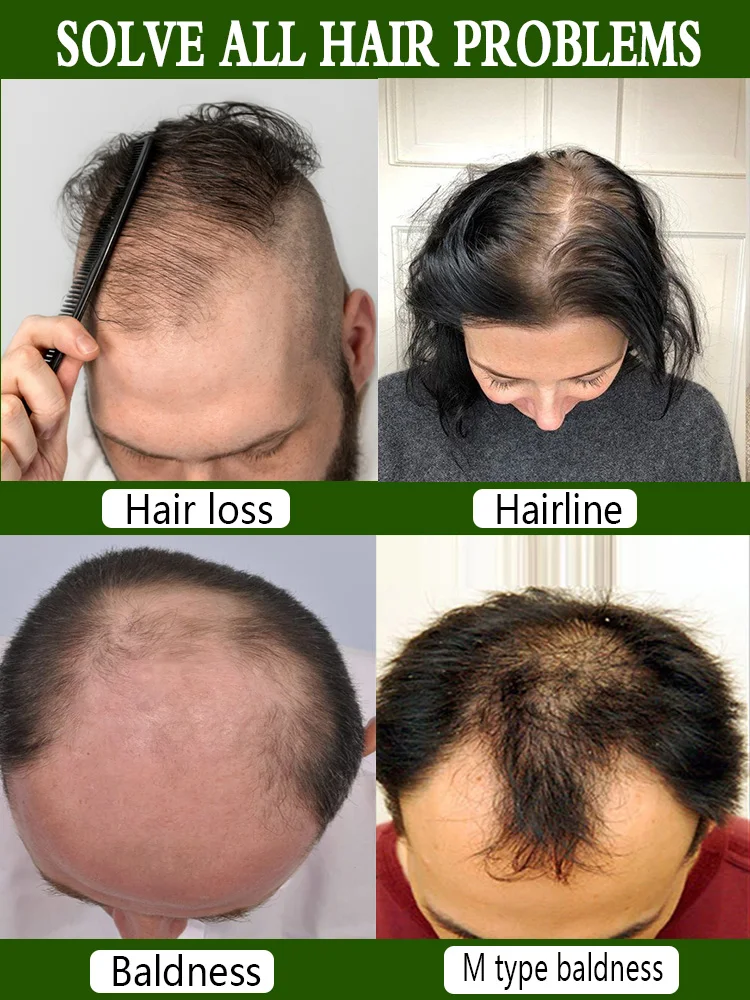 Hair growth essential oil. Effectively repair baldness and hair loss symptoms