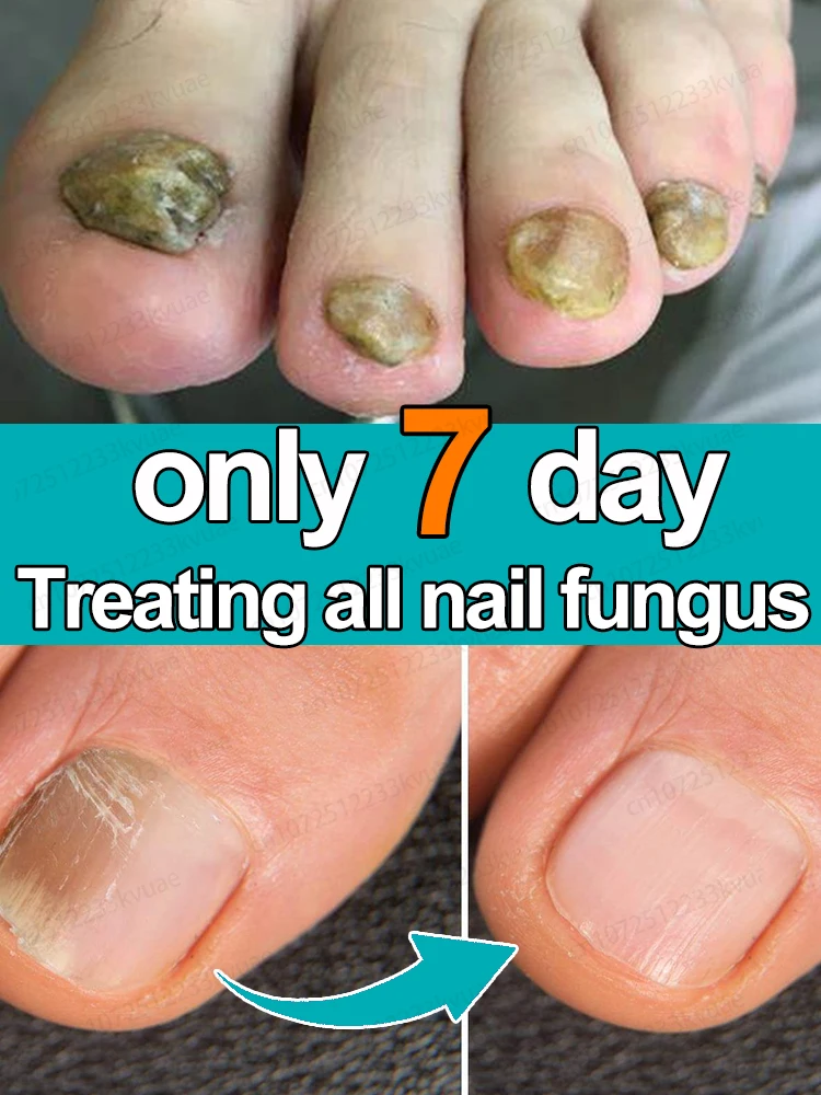 Nail fungus treatment essential oil, repair onychomycosis in 7 days