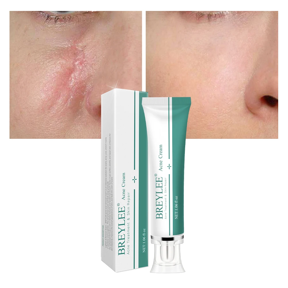 Scar Removal Cream Stretch Marks Acne Scars Skin Repair Dark Spot Remover Face Skin Care face cream,skin cream