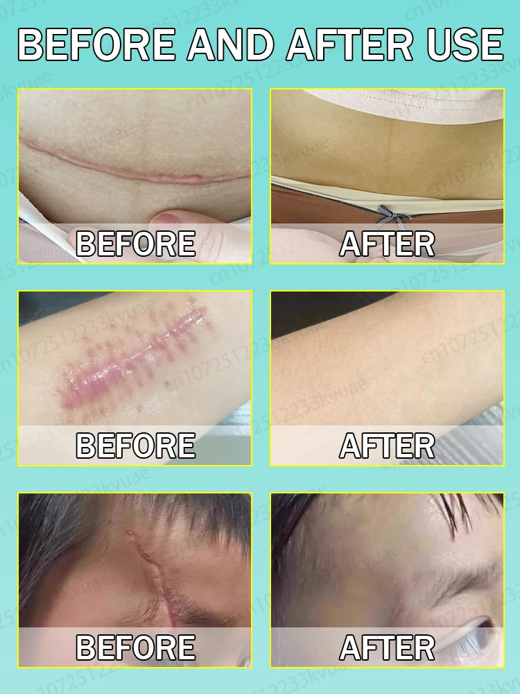 Scar Cream Remove All Scars