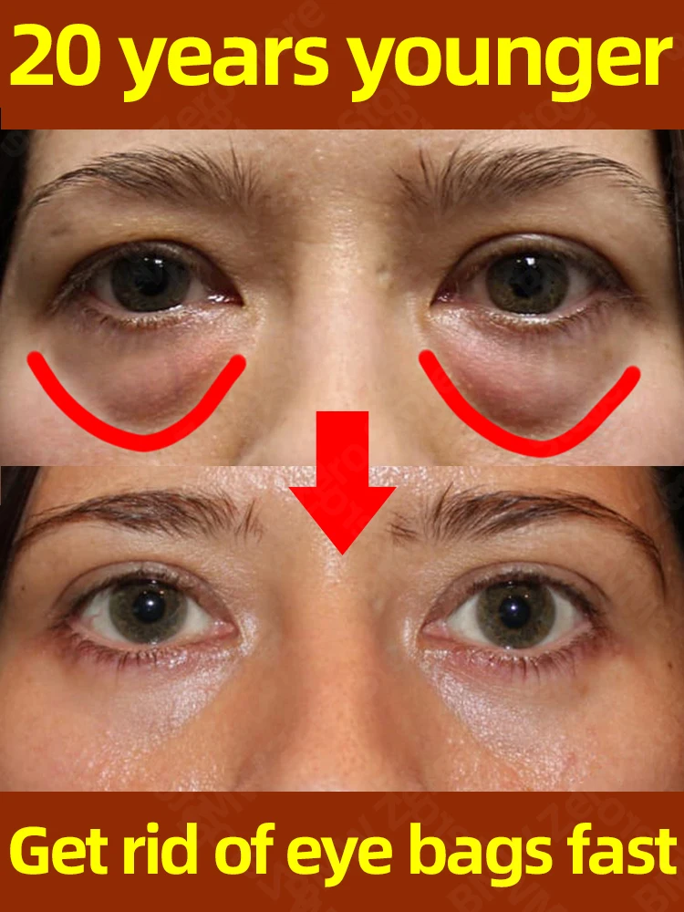 

Dark circles cream and eye bag anti bags in the eyes circle remover