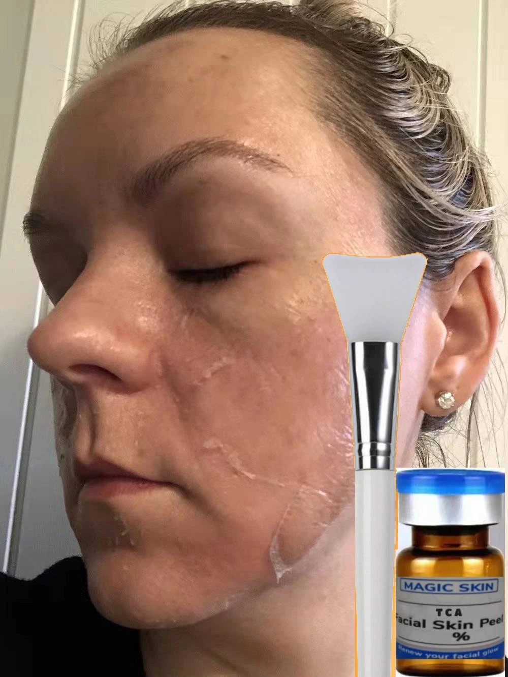 Tca Acid Peel Acid Face Peeling Tca Peel 70 Spots Exfoliating Reduce