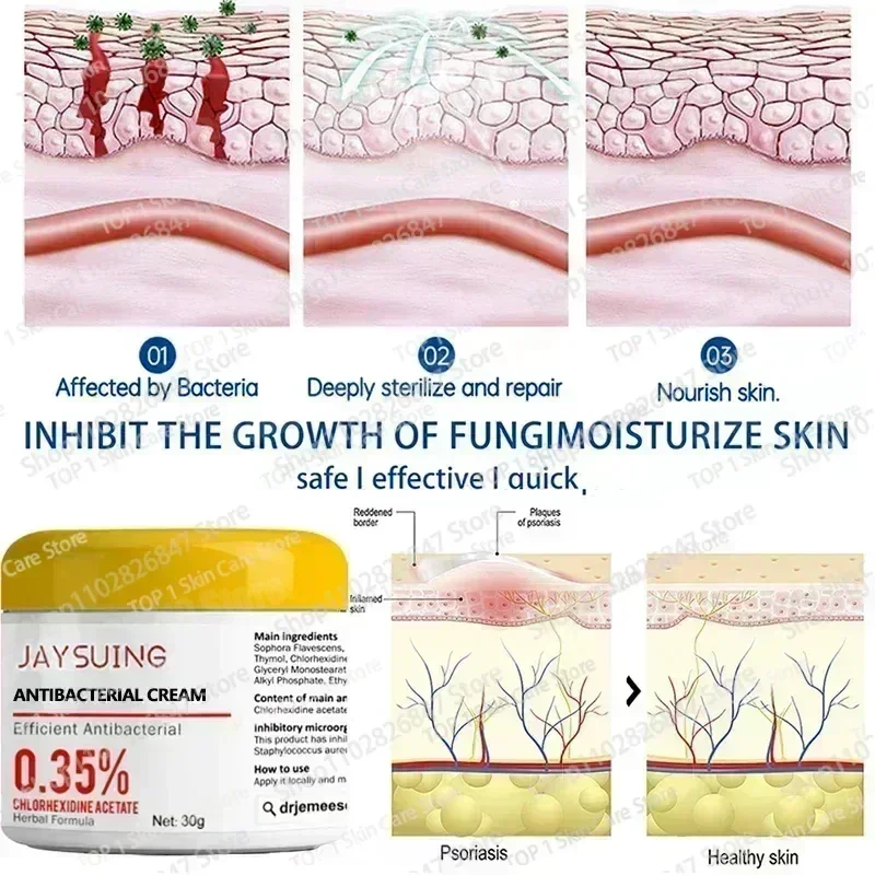 Psoriasis Antibacterial Anti-itch Dermatiti Eczema Urticaria Alergy Skin Beauty Health Body Care