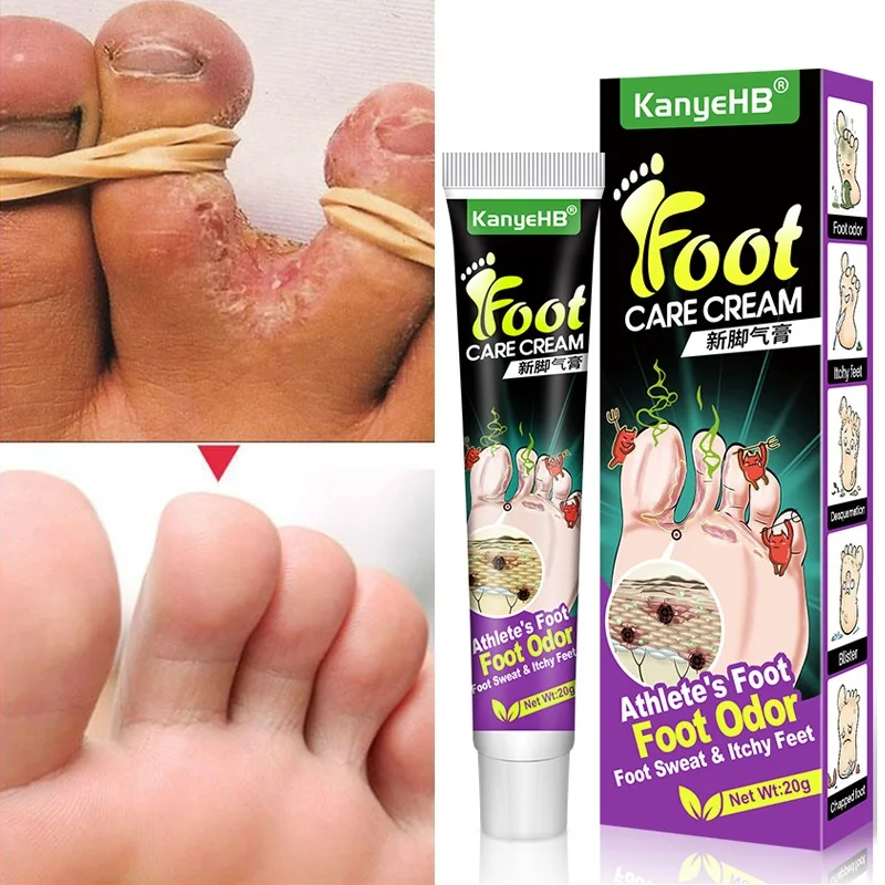 

Foot Fungus Removal Cream Remove Beriberi Dead Skin Anti Fungal Infection Onychomycosis Paronychia Repair Foot Cracked Feet Care