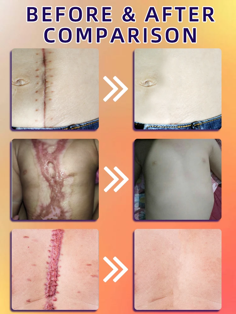 Scar Removal Cream for Keloid Burn Surgical Scars