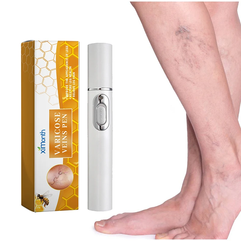 Laser Treatment Varicose Vein Ointment Lampshade Therapy Varicose Veins Legs Relief Dilated Vasculitis Phlebitis Blood Circulation