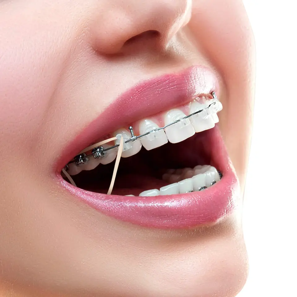 100-Pack Dental Rubber Bands (Ortho Elastics) - Latex Braces Bands In 3.5oz, 4.5oz, 6.5oz Strengths