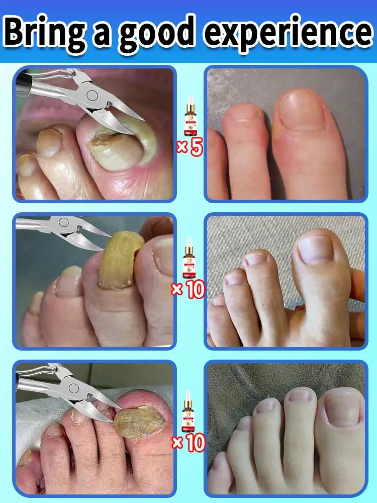 latest effective hawkbill nail clippers, remove ingrown nail, solve thick nail and help oil absorption