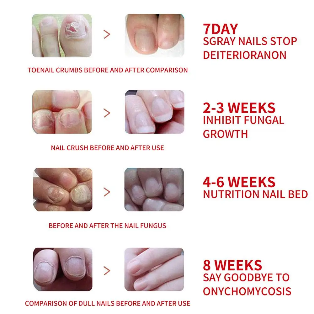 Nail Fungus Remover 20ml Nail Fungal Treatment Essence Oil Serum Repair Anti Infection Gel