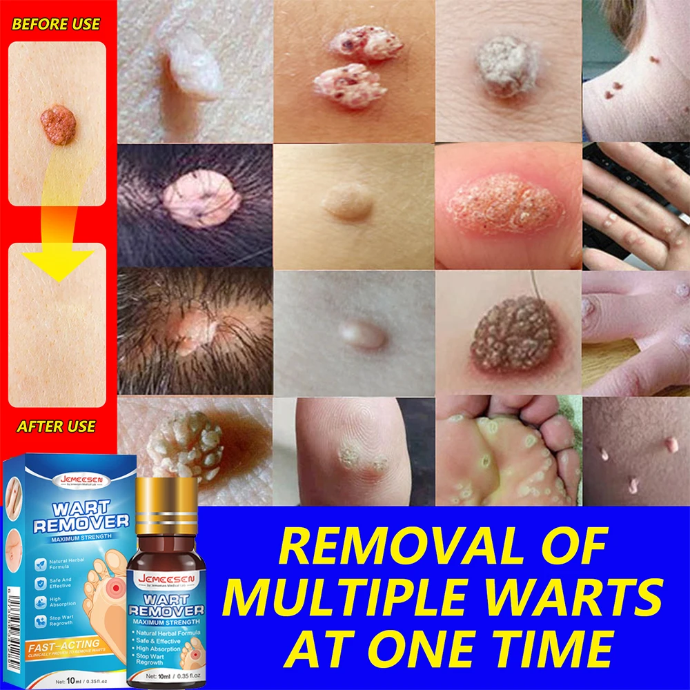 Jemeesen Verruca Removing Liquid 10ml Skin Tag Remover Corn Dark Spot