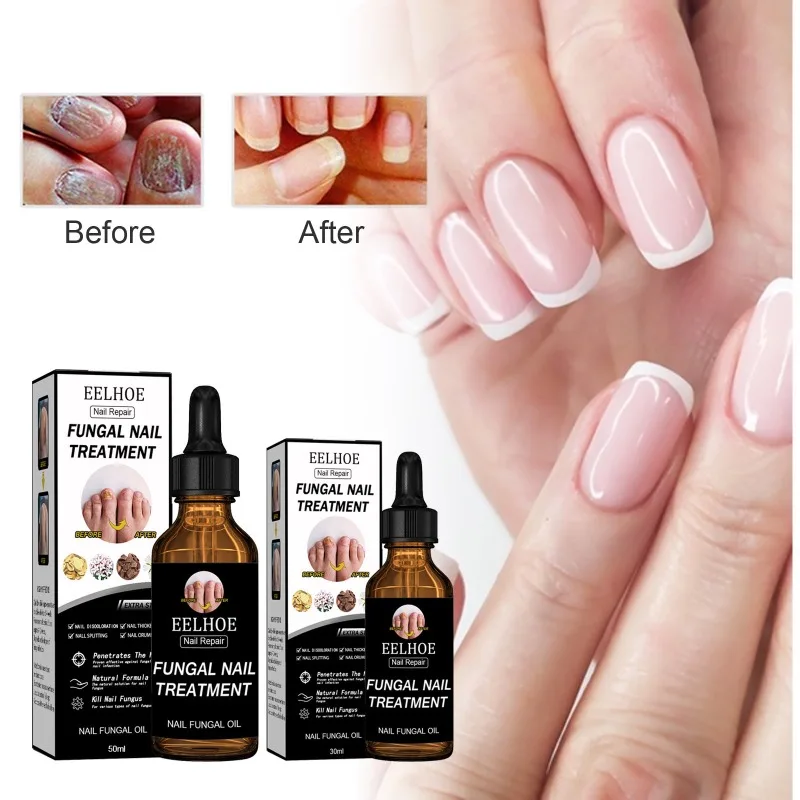

Nail Fungals Renewal Nail Repair Liquid for Discolored Thickened Crumbled Nails Nail Fungals for Discolored Broken Cracked