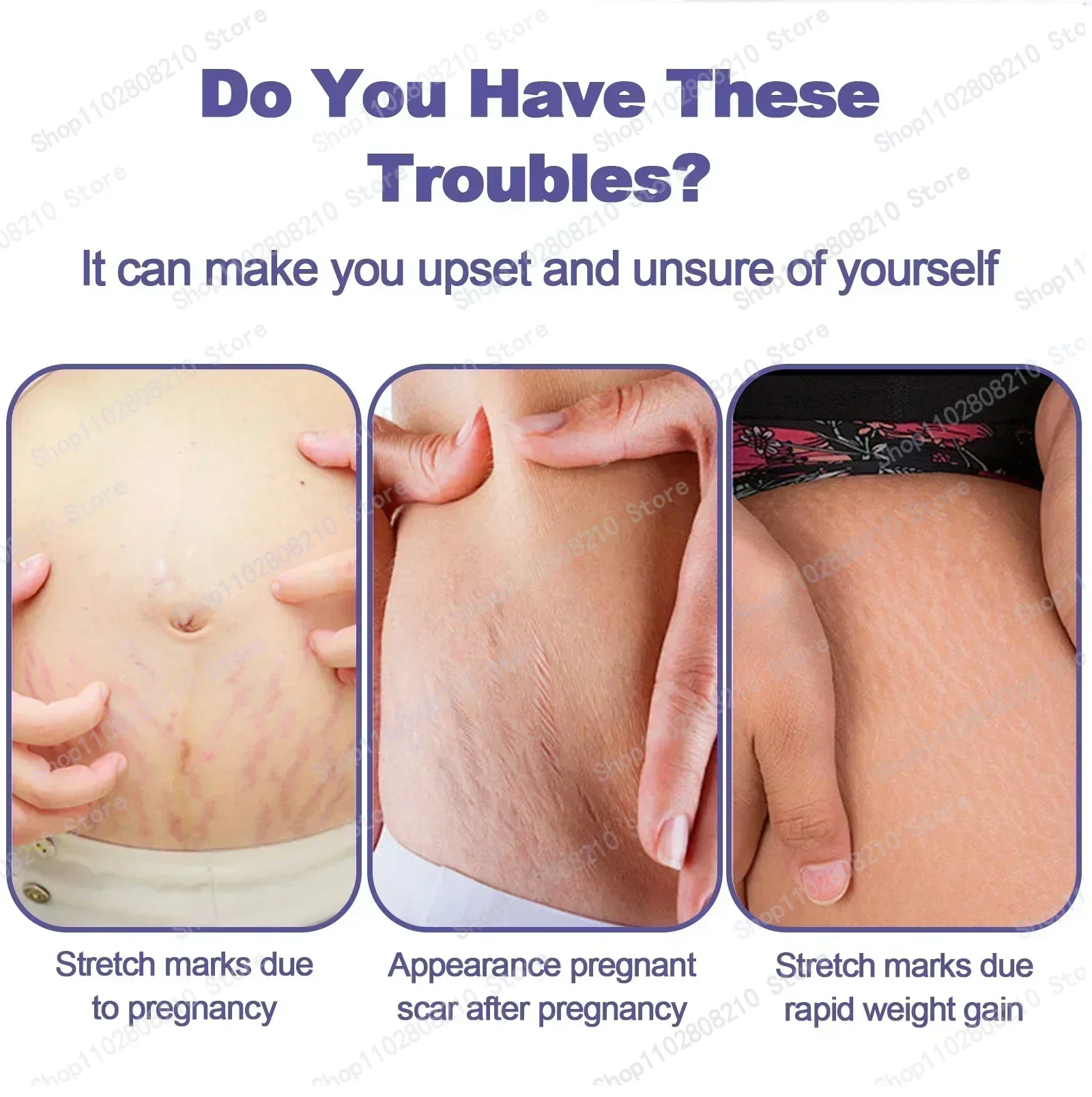 Cream For Pregnancy Stretch Marks Removal Eliminate Red White Old Stretch Marks Oil