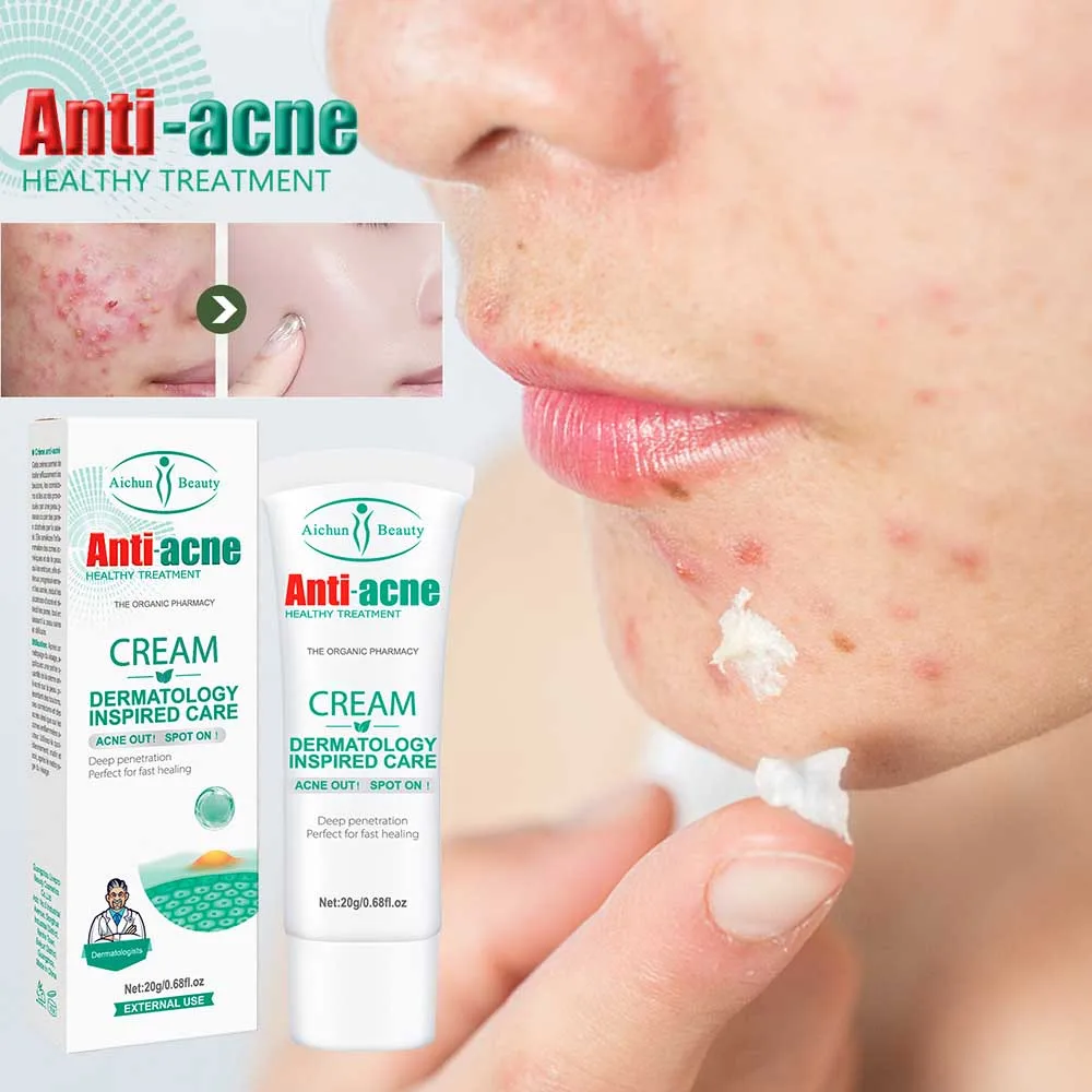 Effective Acne Removal Cream Herbal Acne Spots Oil Control Acne Cream