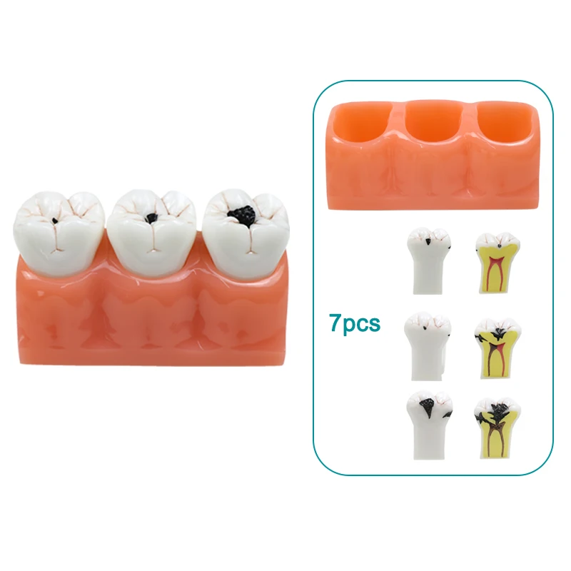 

1 Piece 4:1 Size Dental Caries Removable Teeth Tooth Model Learn Study Model Dental Materials