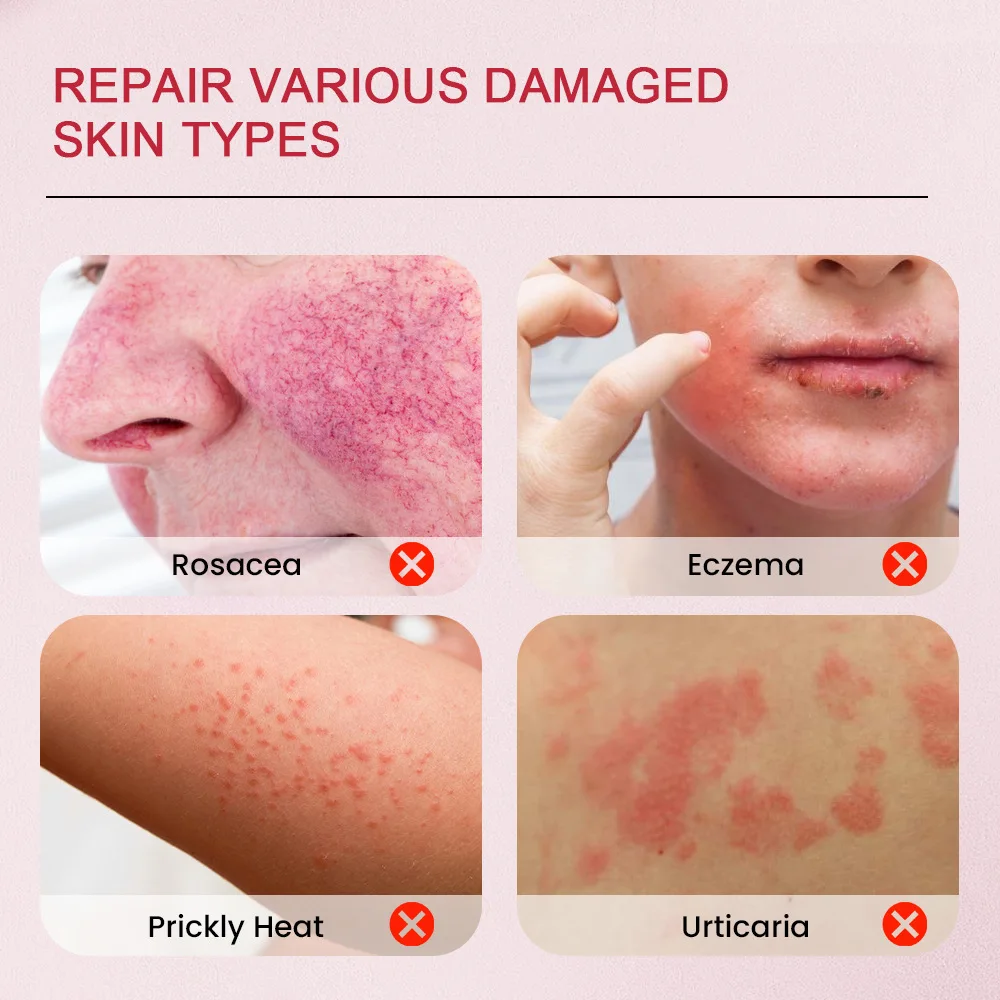 Sumifun, calamine, wet poison ointment, antiseptic plaster, itching skin care