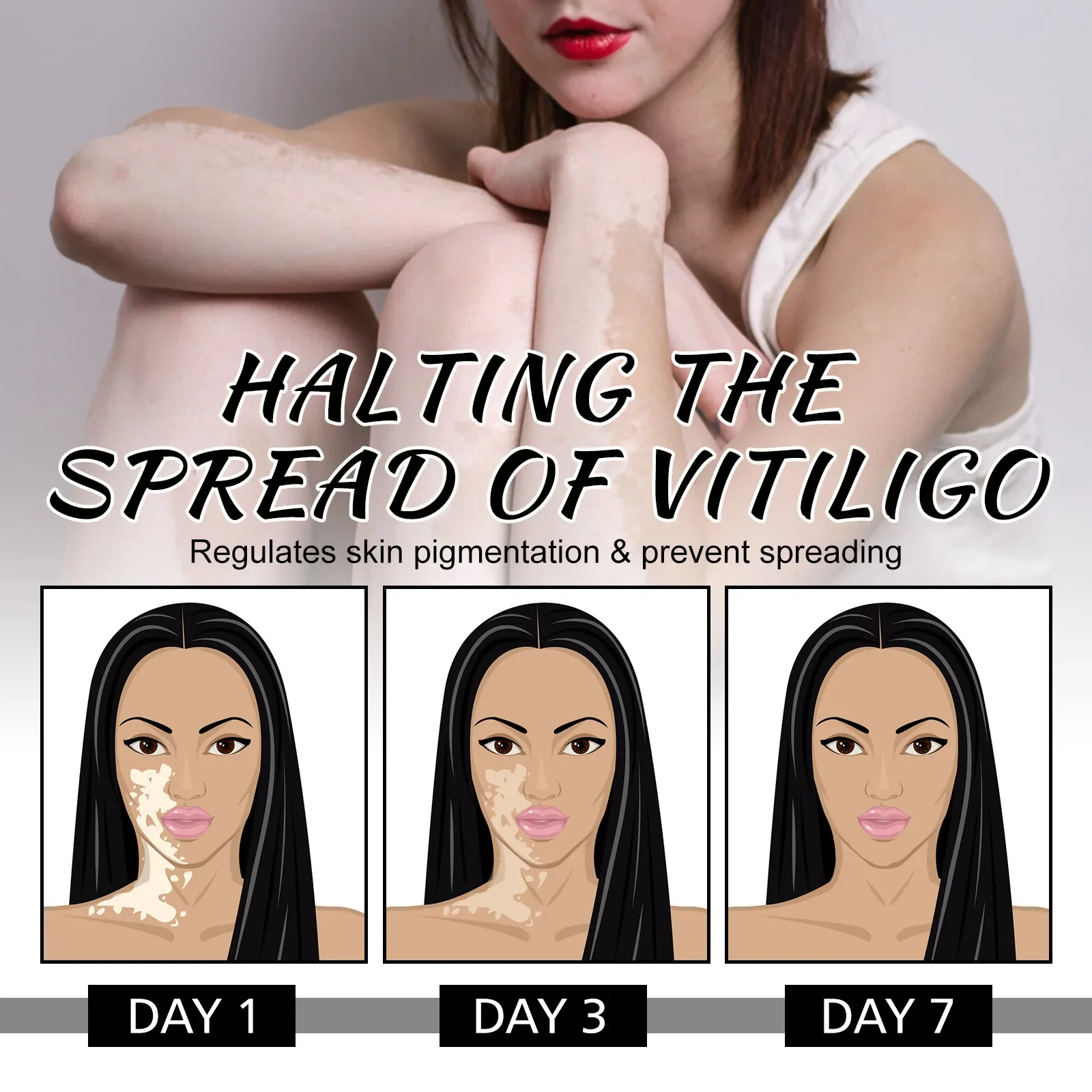 Spray anti-Vitiligo, élimine les taches blanches de la teigne, élimine les taches de sueur, traitement de la leucoplasie, répare, hydrate la peau, liquide de soin_voghion.com