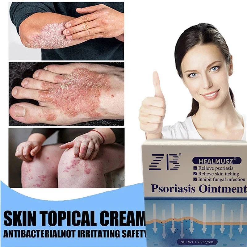 

50g Psoriasis Cream Antibacterial Anti-itch Relief Dermatitis Eczema Treatment Urticaria Peeling Dermatitis Urticaria Ointment