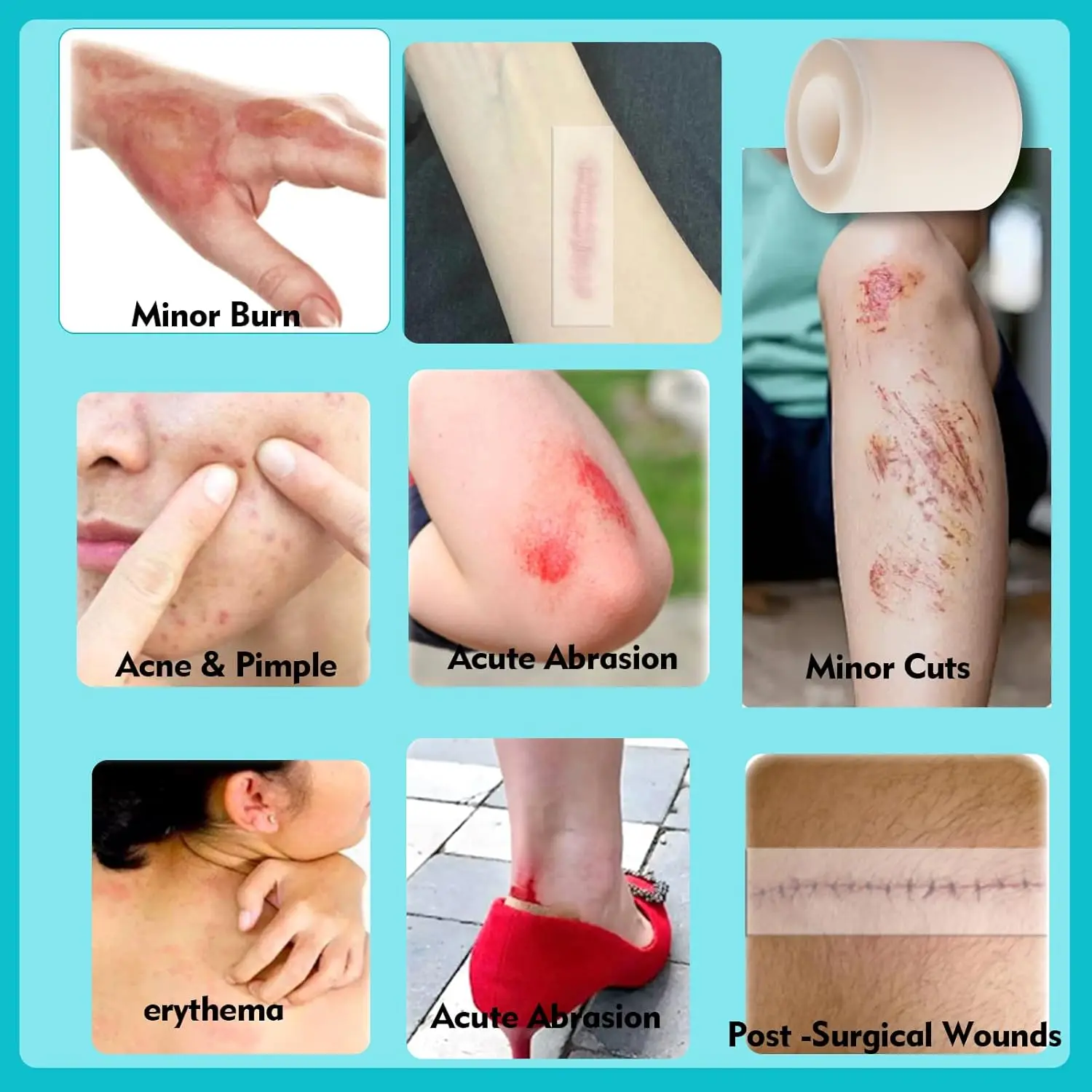 Hydrocolloid Patch Bandages Self-Adhesive Medical-Grade Bed Sore Bandages Acne Care Sterile and Waterproof First Aid Care Tool