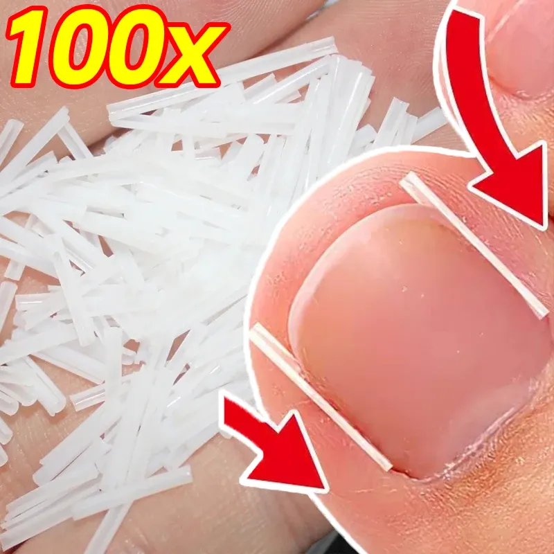 10/200pcs Ingrown Toenail Correction Tool Invisible Ingrown Toe Nail Treatment Pad Groove Straightening Clip Brace Foot Care